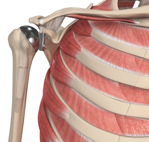 Shoulder Replacement in Bangalore